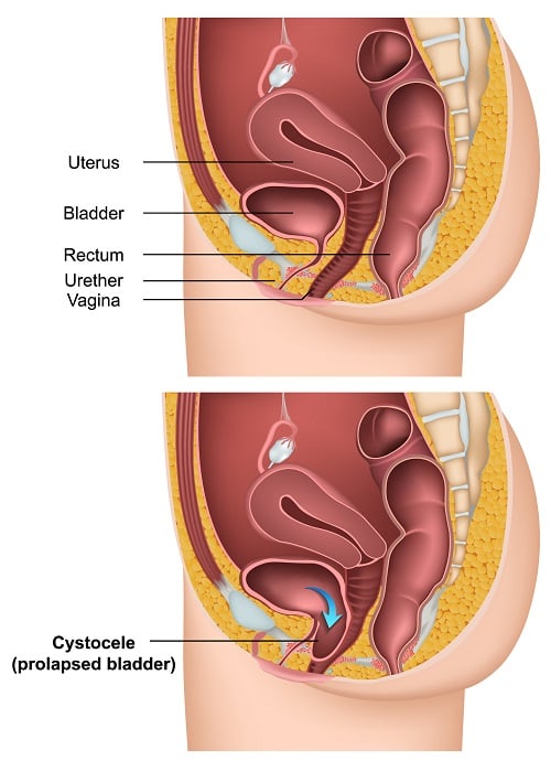 Cystocele