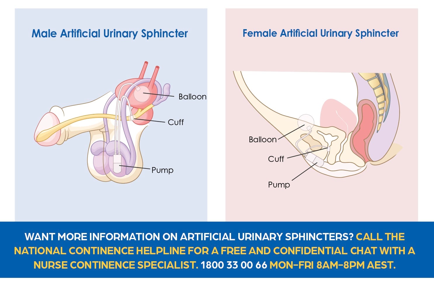 Male Artificial Urinary Sphincter
