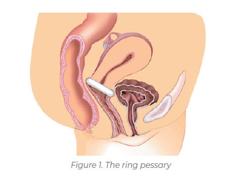 inserting pessary ring